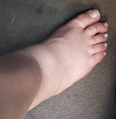 Edema of the foot and lower leg caused by pregnancy. A bare foot on carpet with a visible indentation caused by shoes.